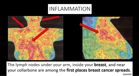 Inflammation lymph nodes thermal image