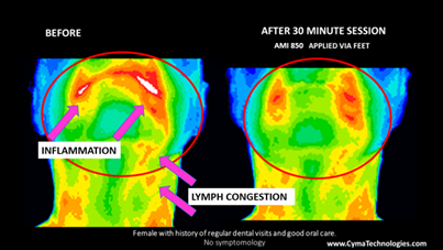 Lymph congestion thermal imaging