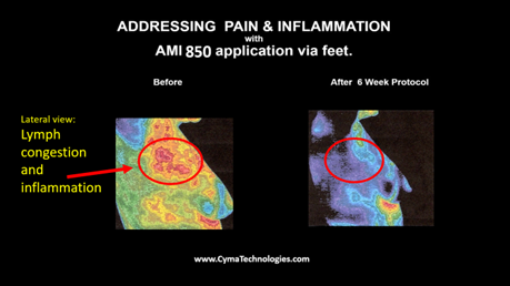 Addressing pain and inflation thermal images