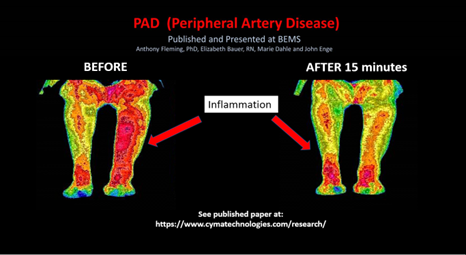 PAD (Peripheral Artery Disease) thermal image